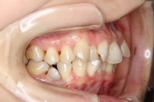 右下の第二小臼歯が虫歯になっています